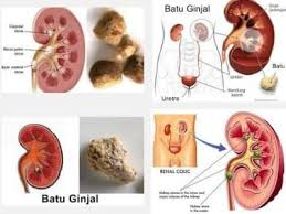 Illustration for article titled Penyakit Yang Disebabkan Oleh Batu Ginjal